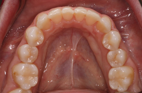 invisalign-after