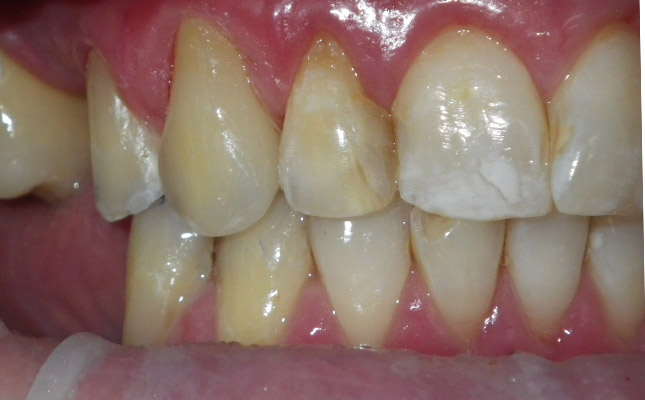 invisalign-before