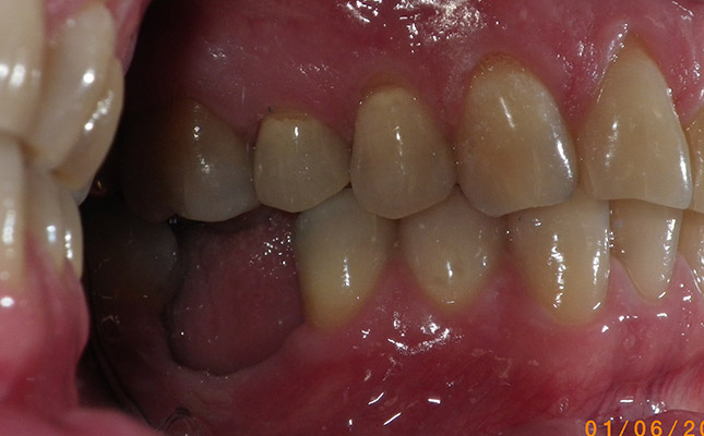 invisalign-before