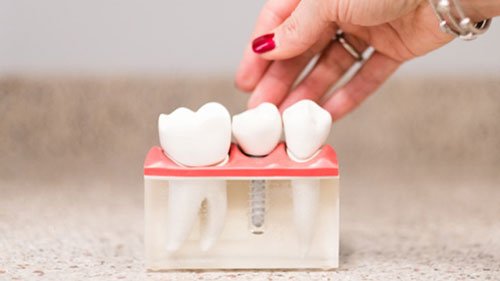 Model of dental implant teeth
