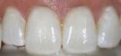 white-teeth-after