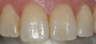 white-teeth-before