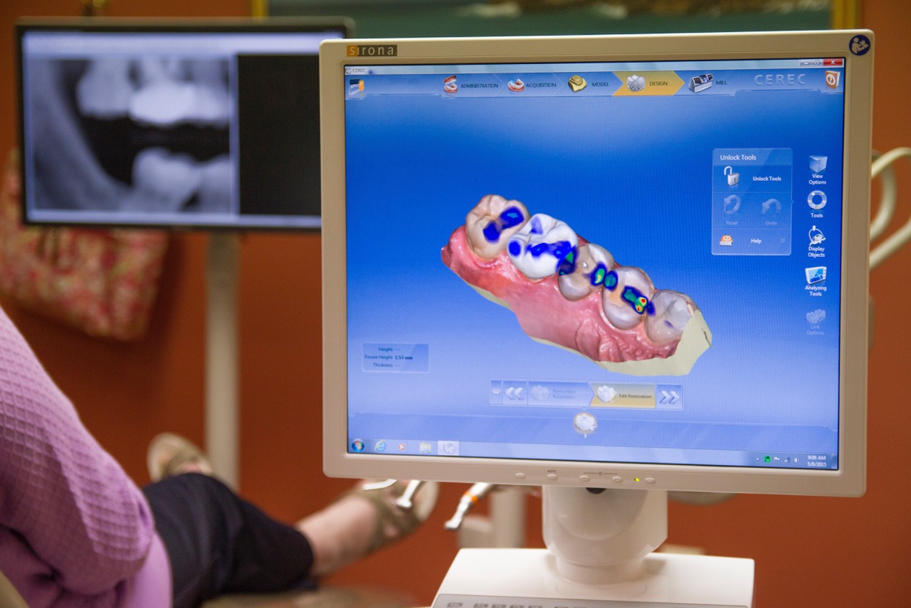 CEREC 3D Image