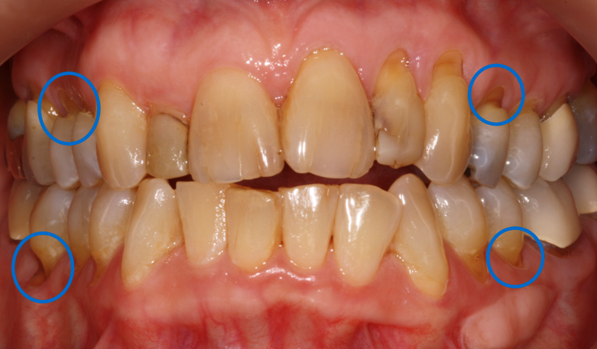 Occlusal disease 1