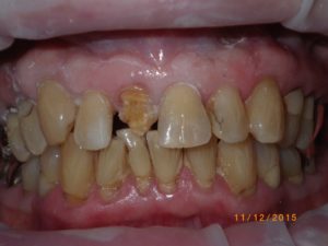 Pre Dental Crowns Pre Dental Crowns