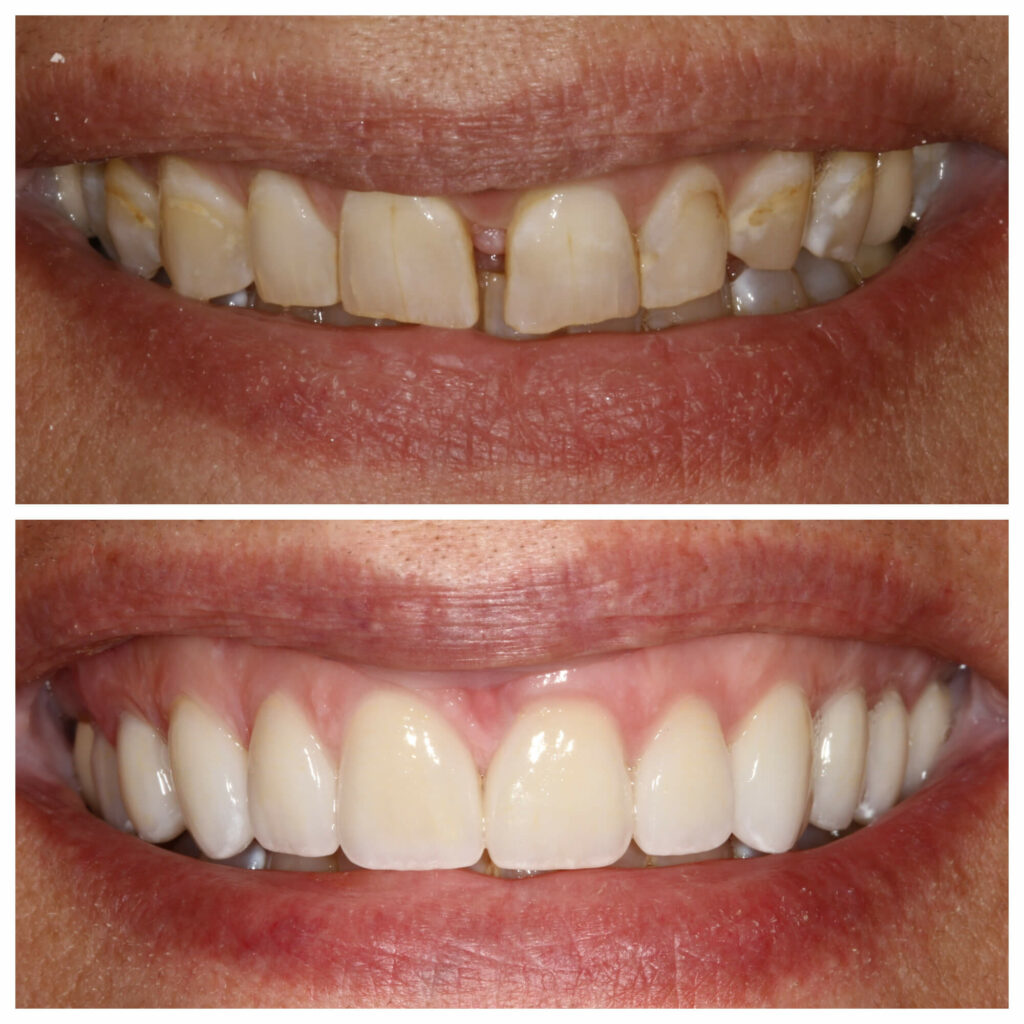 tooth gap correction