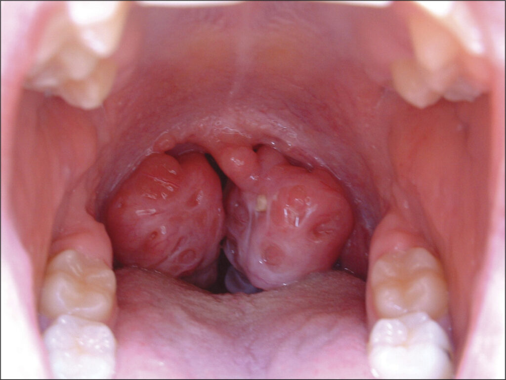 Tonsils